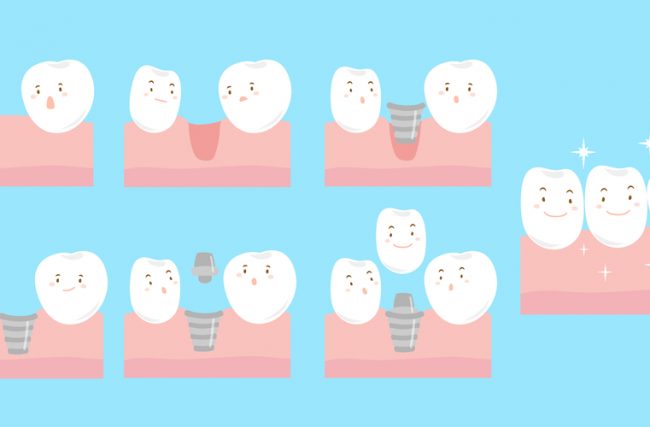 Rejeição de implantes dentários: acontece?