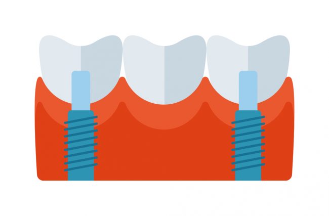 Implante dentário dói? Tire essa e mais 6 dúvidas sobre implantes