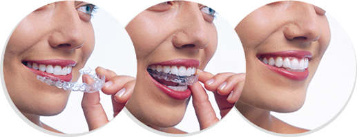 Aparelho fixo transparente ou aparelho invisível: quais as principais  diferenças – Fabiola Bafutto – Dentista Brasília